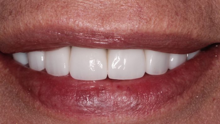 post veneers