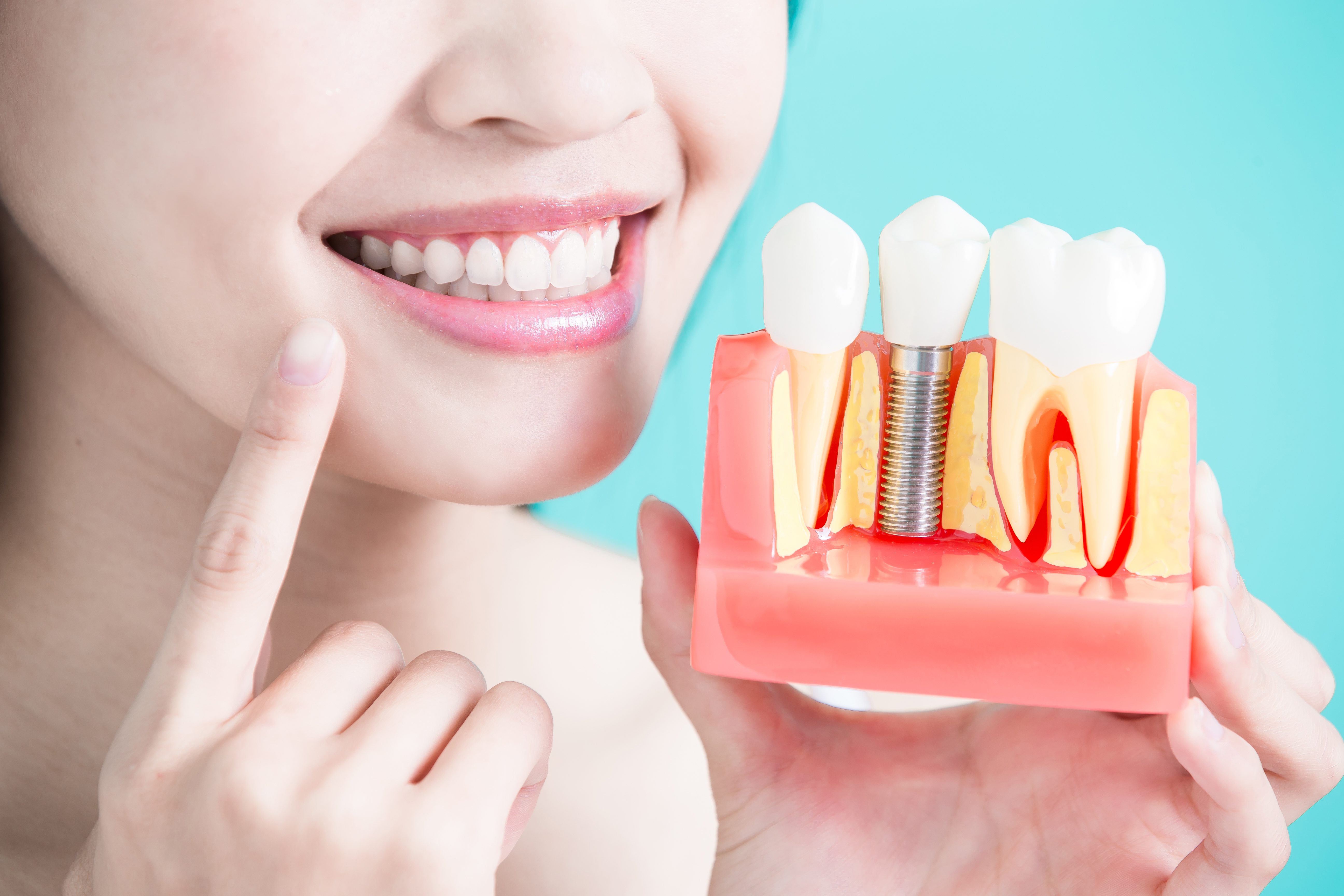 Dental Implants Adelaide Adelaide Smile and Implant Centre